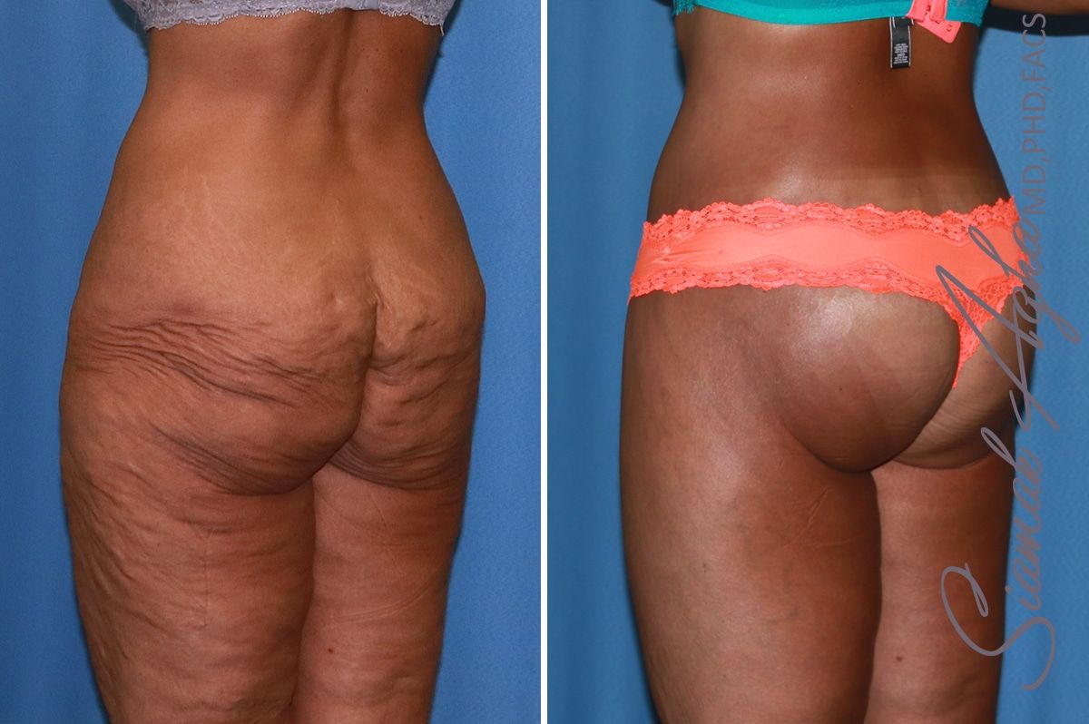 Lower Body Lift Before & After