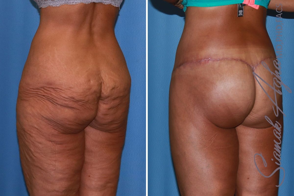 Lower Body Lift Before & After
