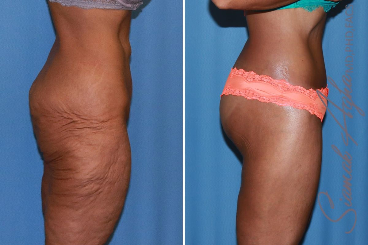 Lower Body Lift Before & After
