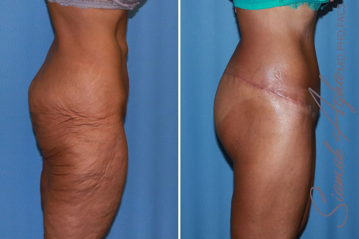 Lower Body Lift Before & After