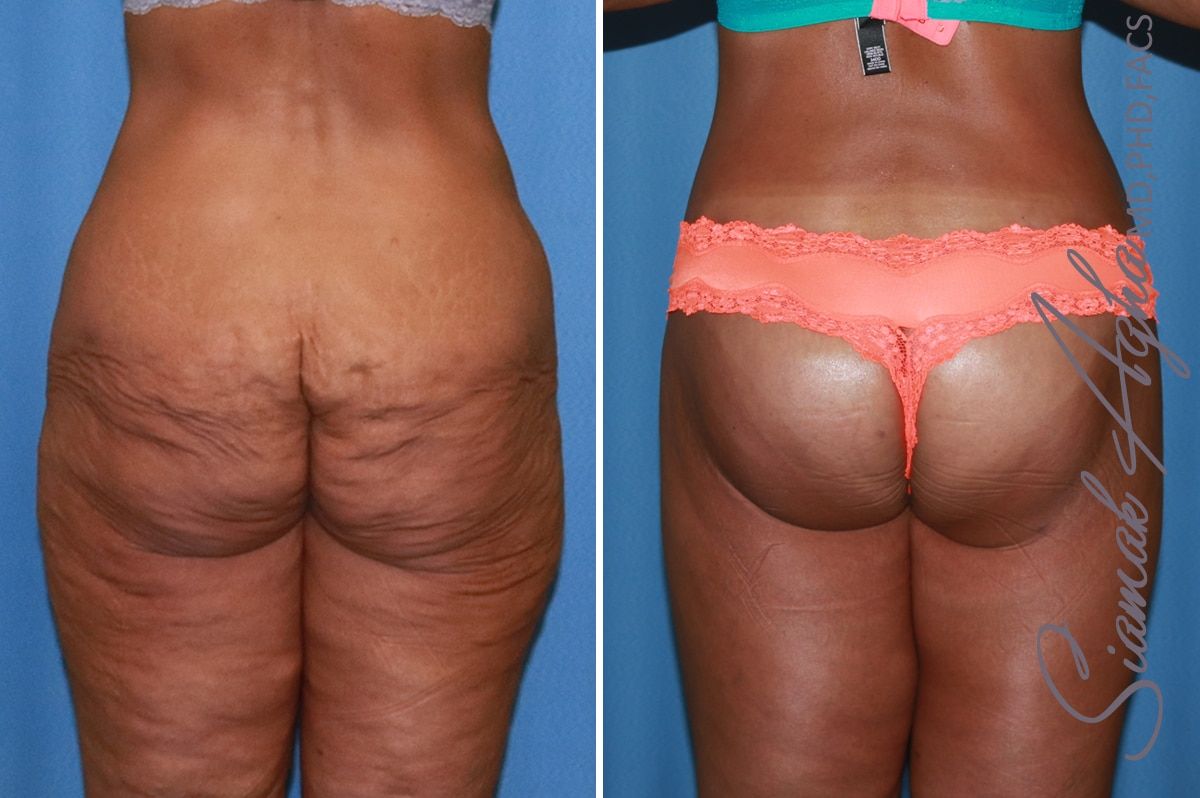 Lower Body Lift Before & After