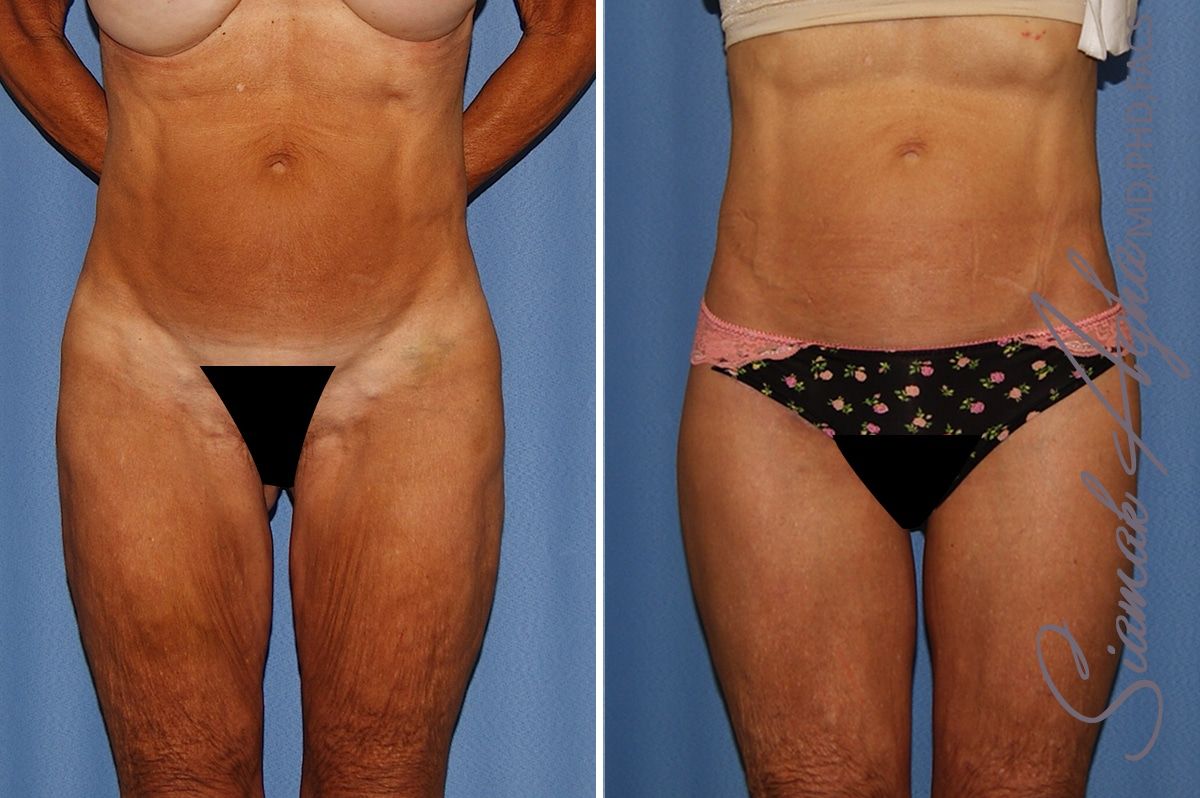Lower Body Lift Before & After