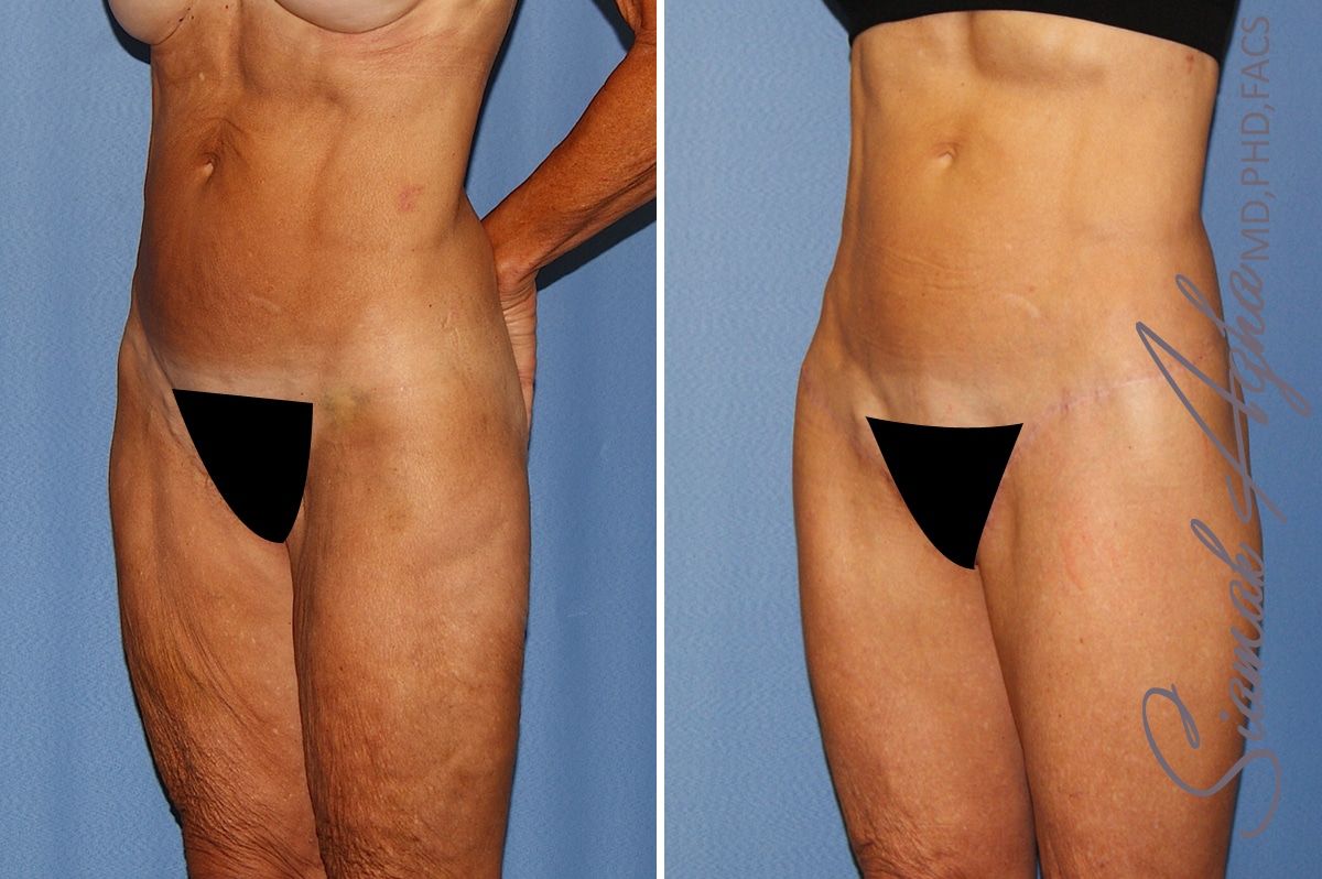 Lower Body Lift Before & After