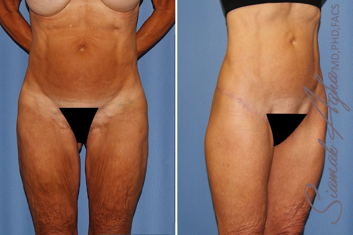 Lower Body Lift Before & After
