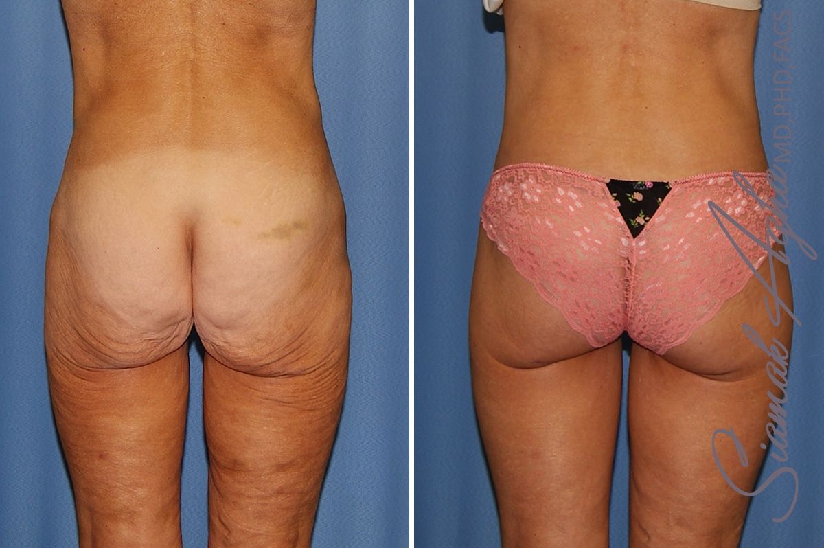 Lower Body Lift Before & After