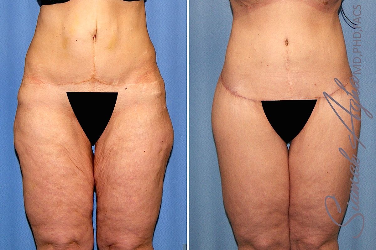 Lower Body Lift Before & After