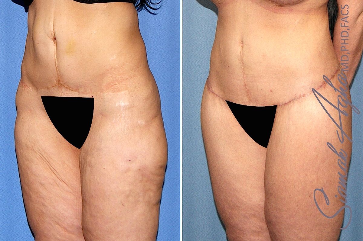 Lower Body Lift Before & After