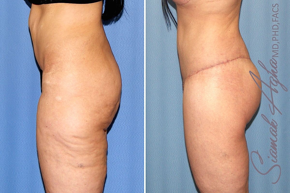 Lower Body Lift Before & After