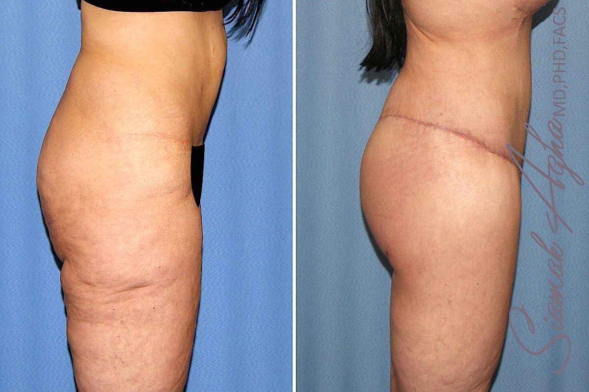 Lower Body Lift Before & After