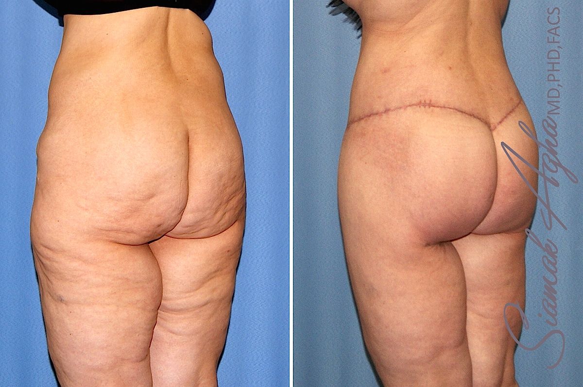 Lower Body Lift Before & After