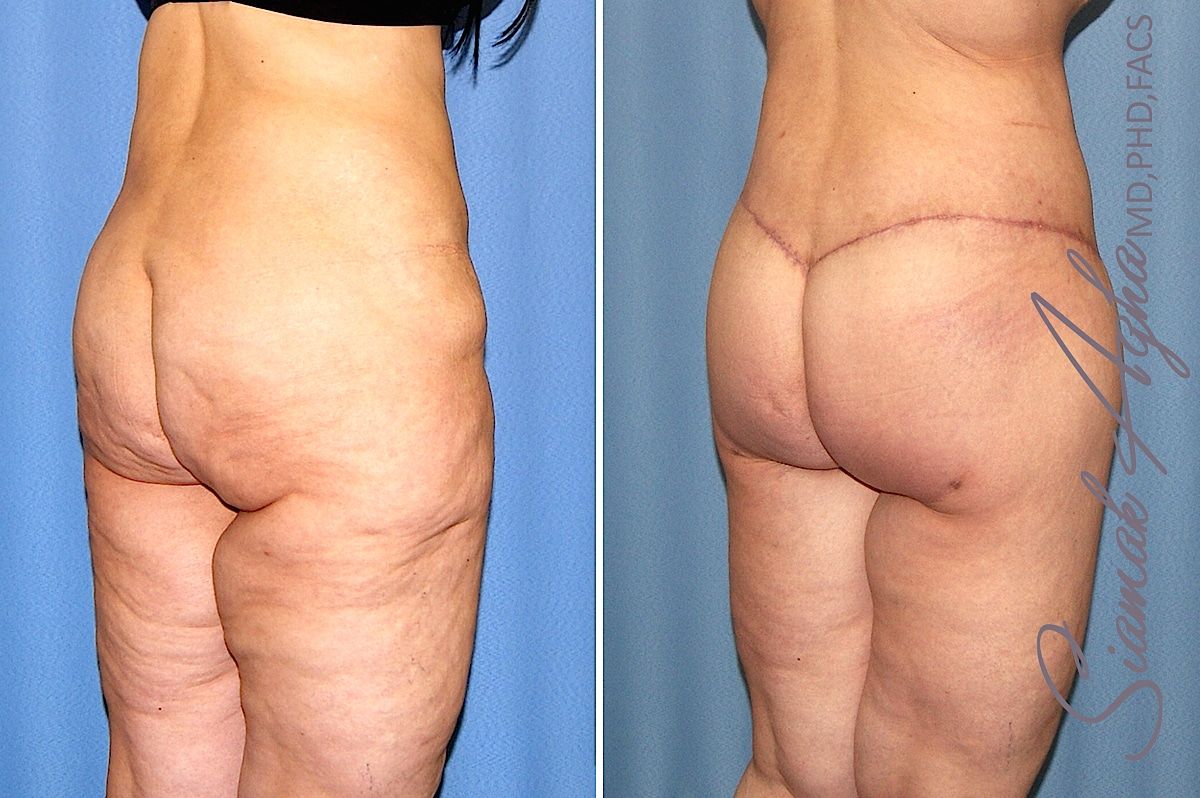 Lower Body Lift Before & After