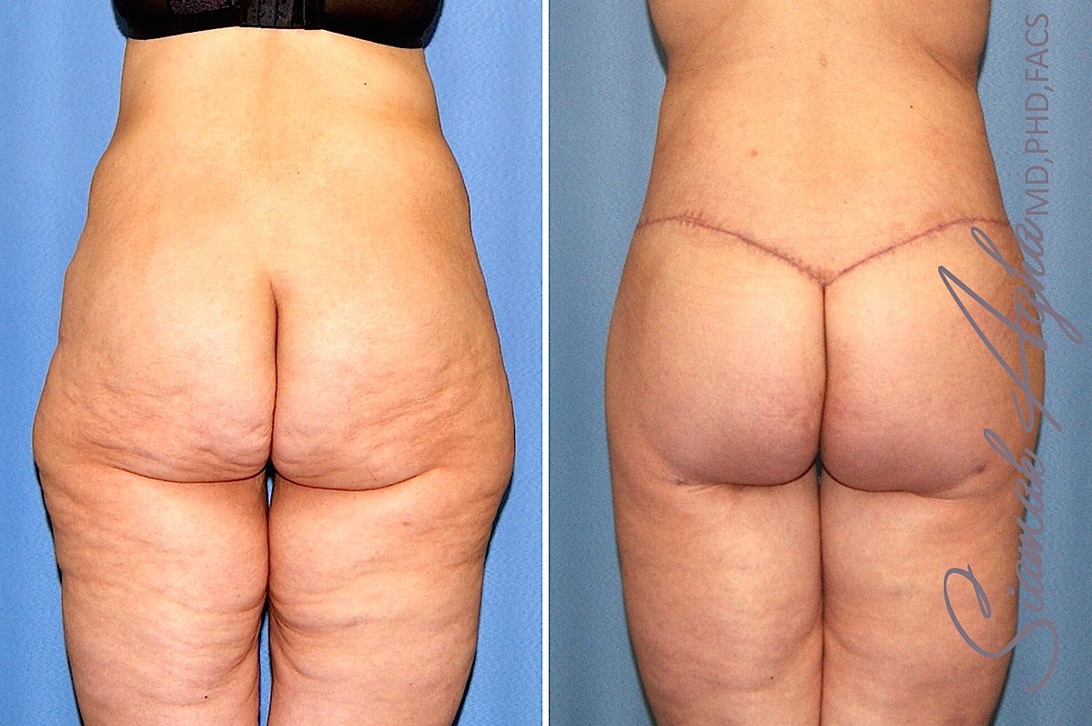 Lower Body Lift Before & After