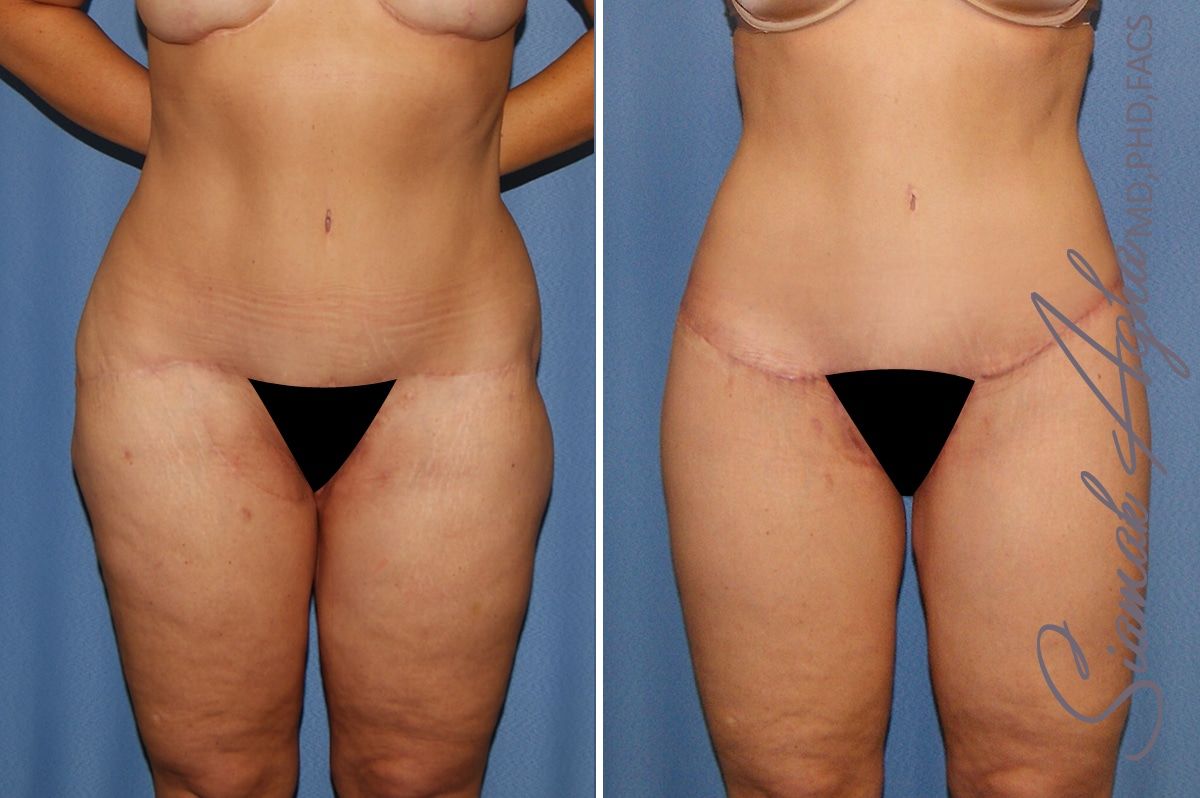 Lower Body Lift Before & After