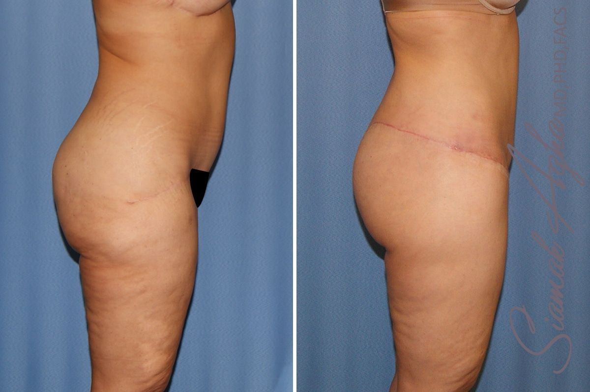 Lower Body Lift Before & After