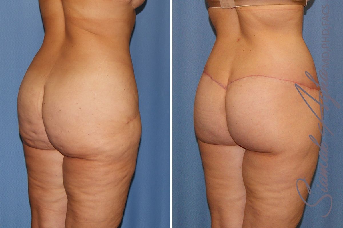 Lower Body Lift Before & After