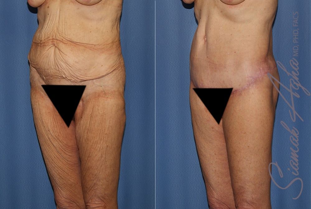 Lower Body Lift Before & After