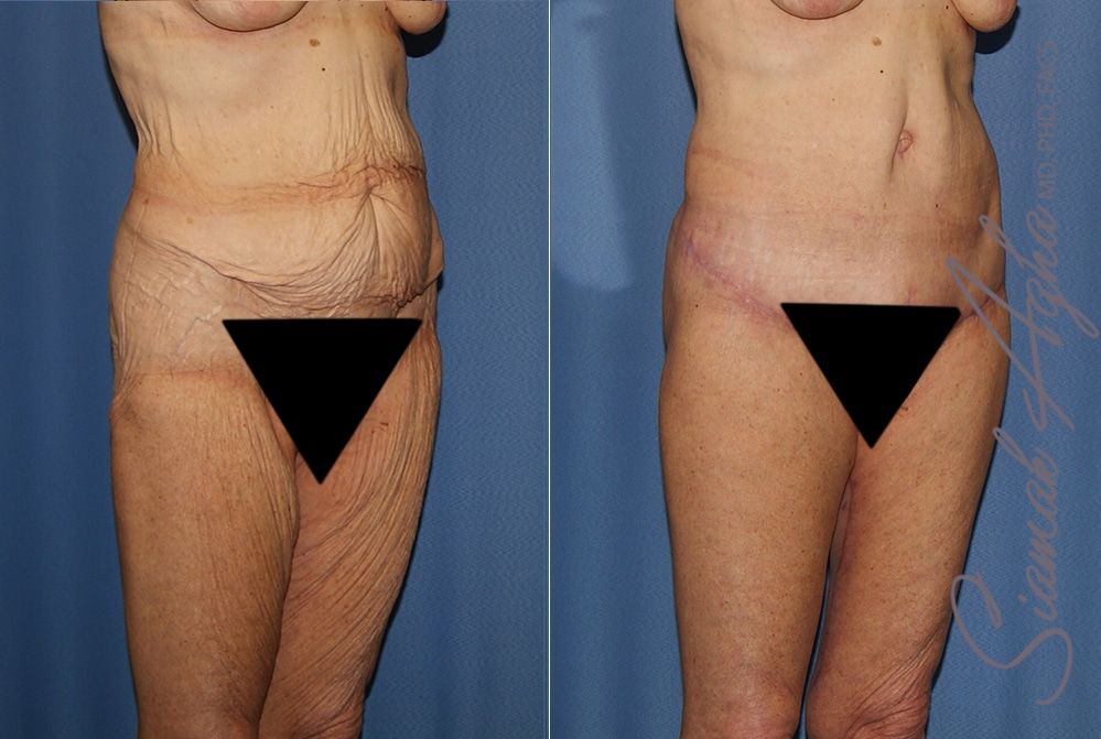 Lower Body Lift Before & After