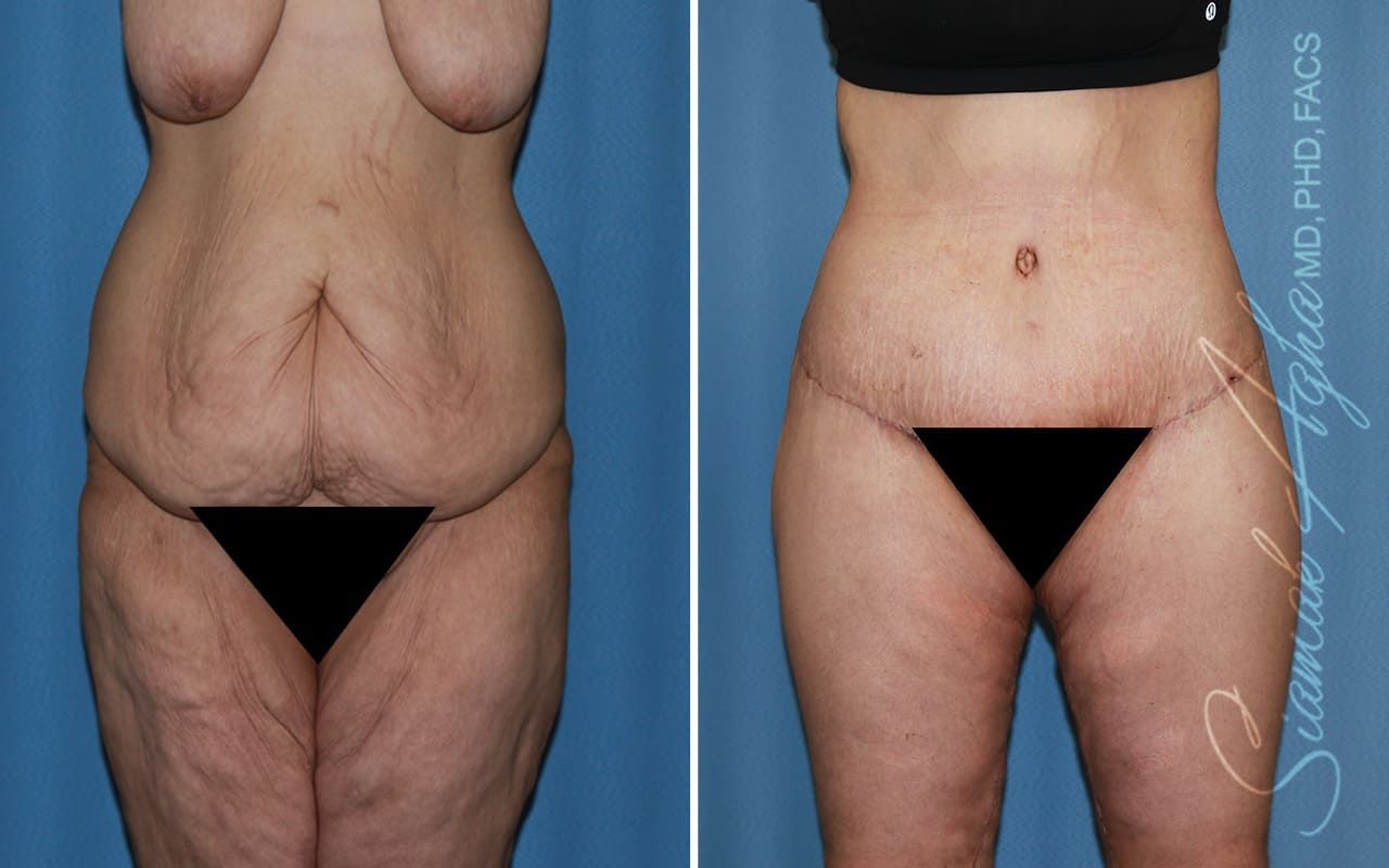 Lower Body Lift Before & After