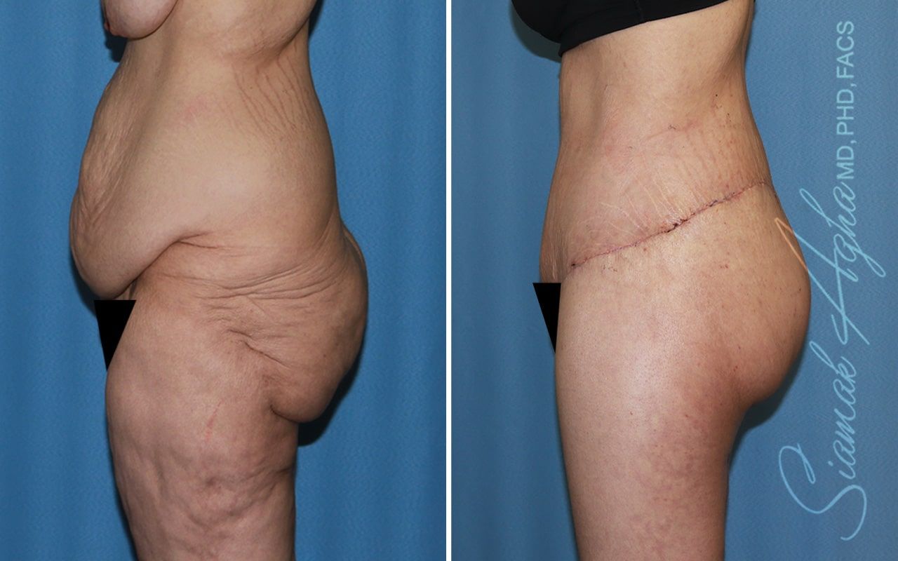 Lower Body Lift Before & After