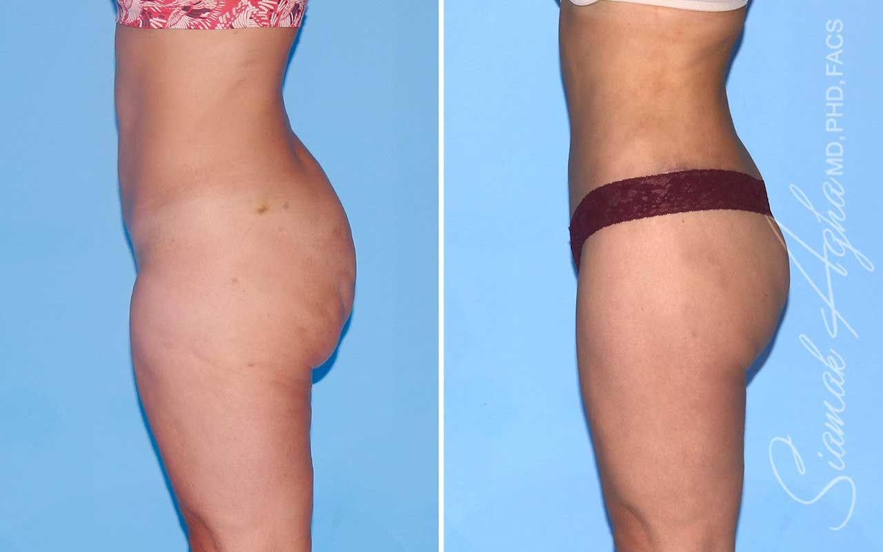 Lower Body Lift Before & After