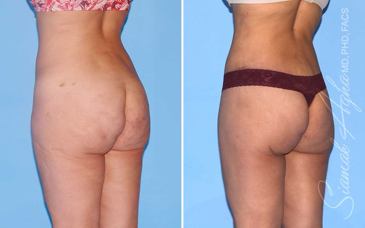 Lower Body Lift Before & After