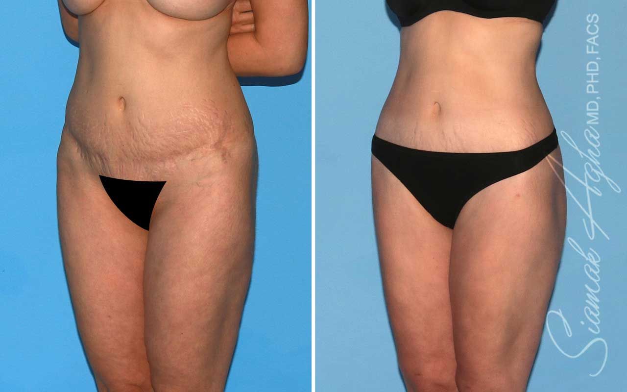 Lower Body Lift Before & After