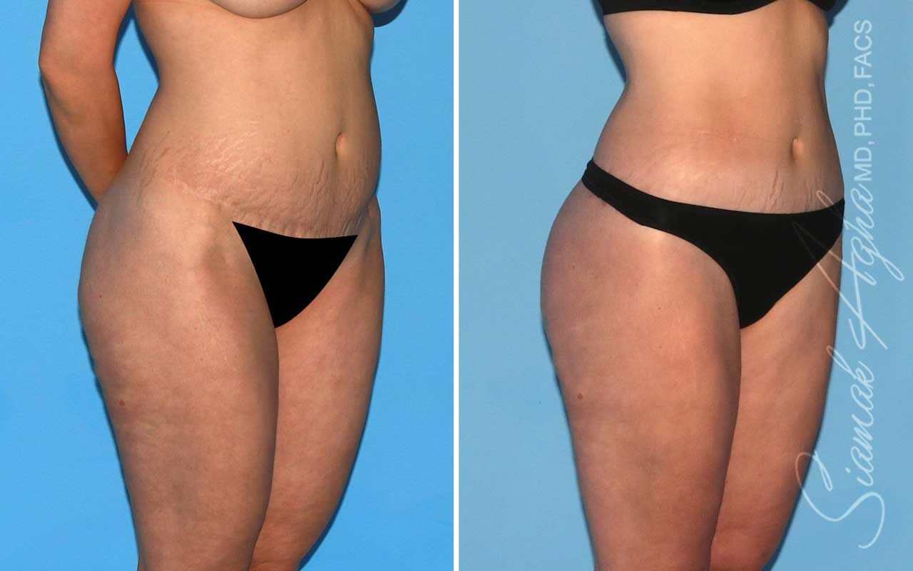 Lower Body Lift Before & After