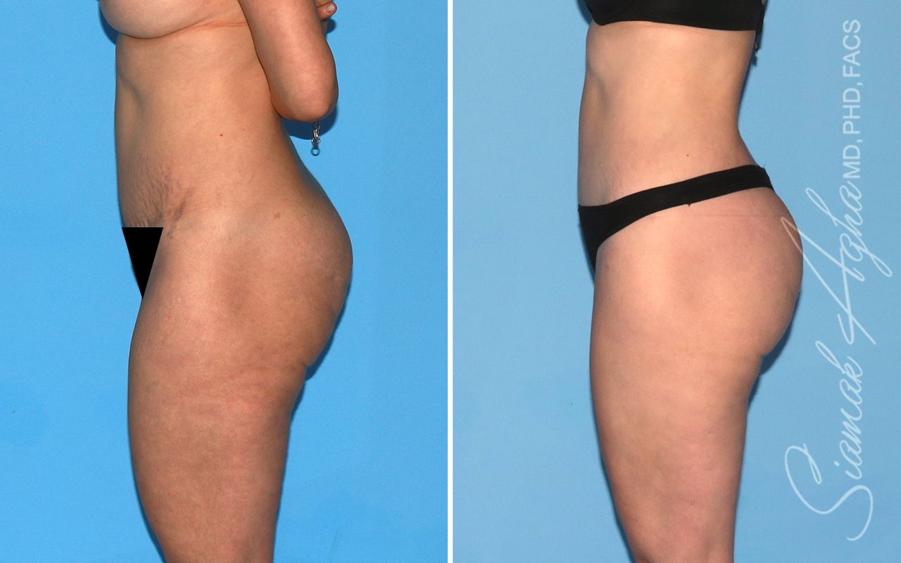 Lower Body Lift Before & After