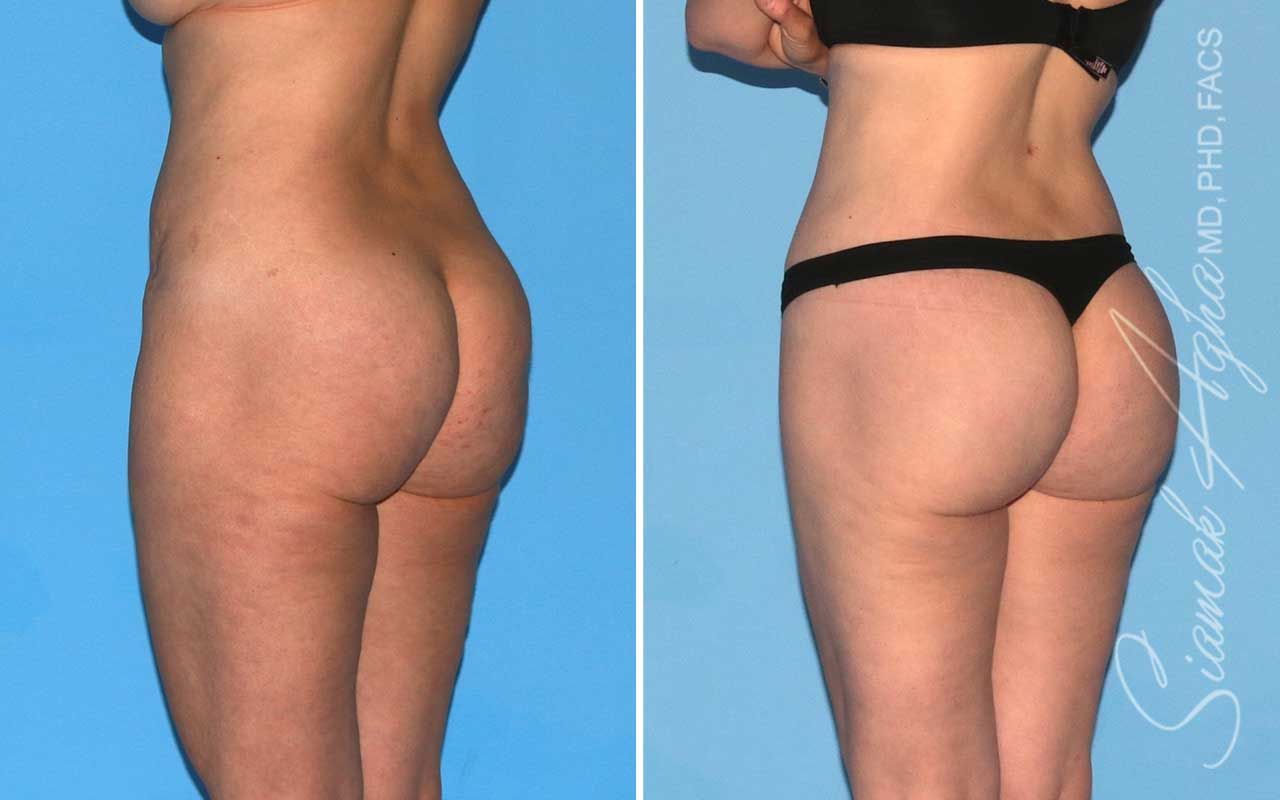 Lower Body Lift Before & After
