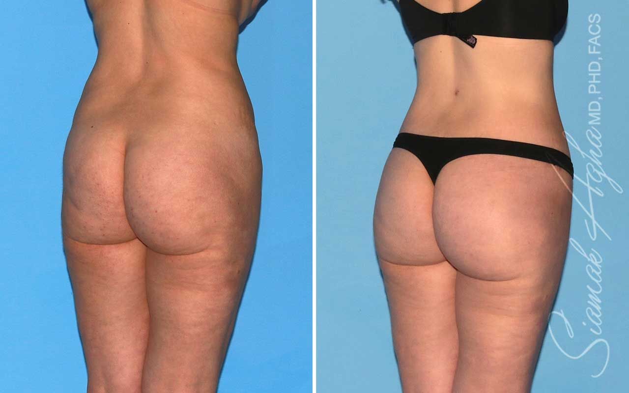 Lower Body Lift Before & After