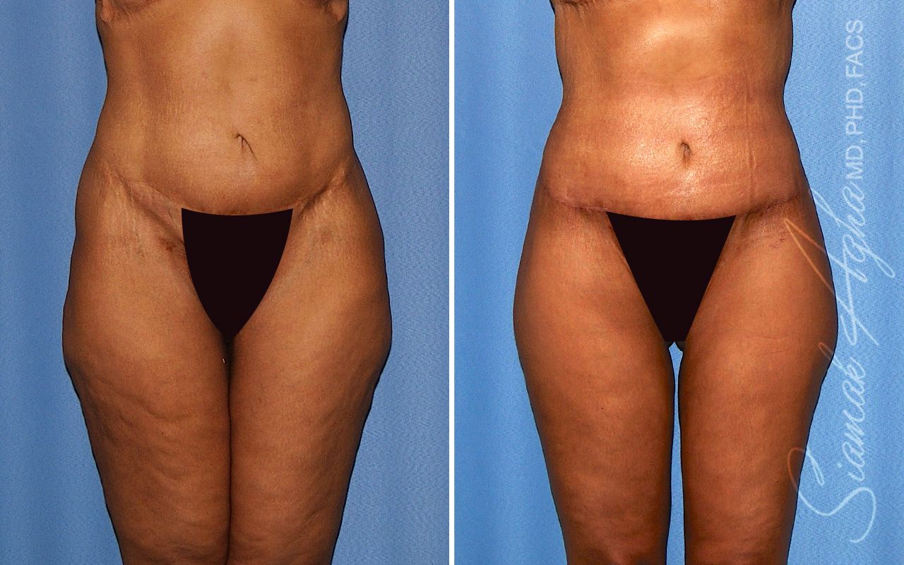 Lower Body Lift Before & After