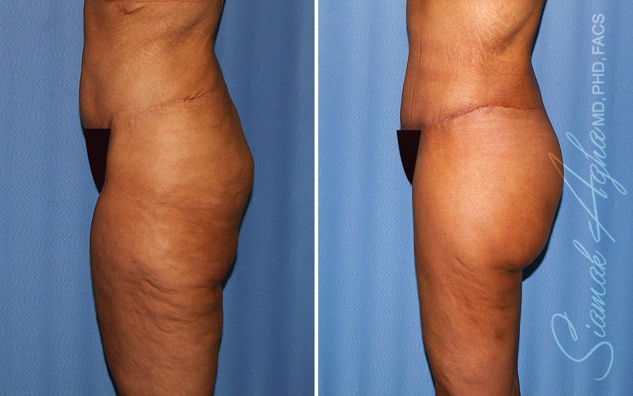 Lower Body Lift Before & After