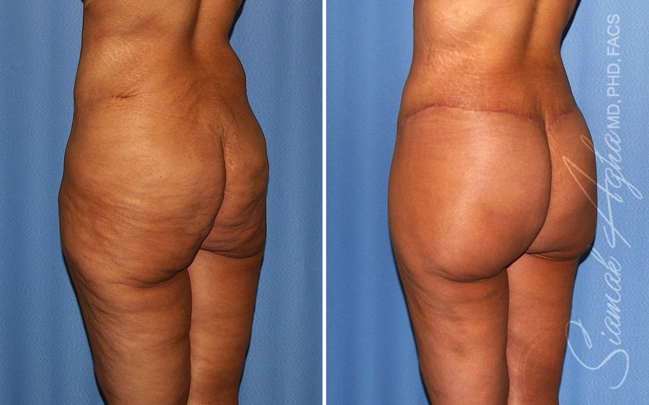 Lower Body Lift Before & After