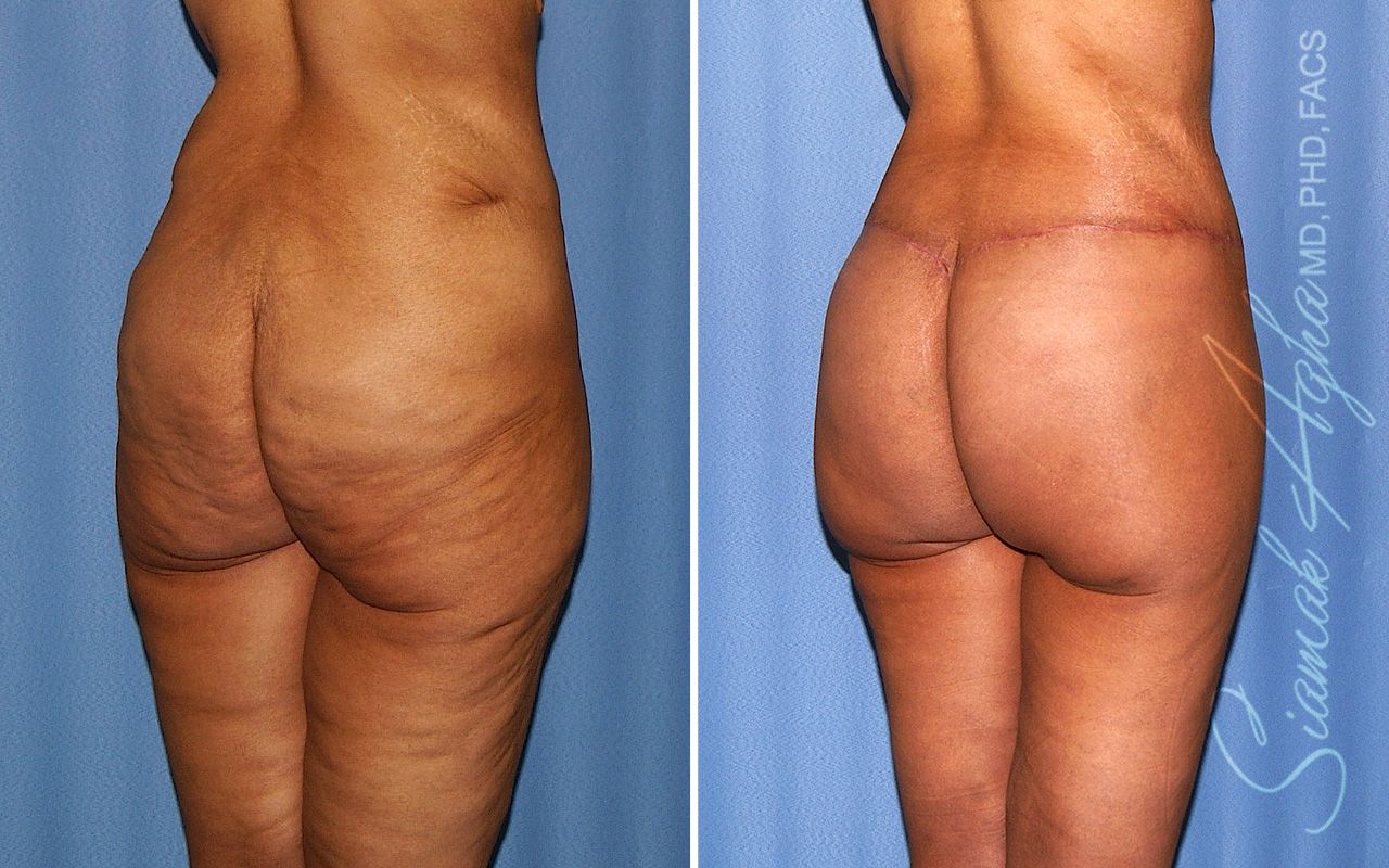 Lower Body Lift Before & After