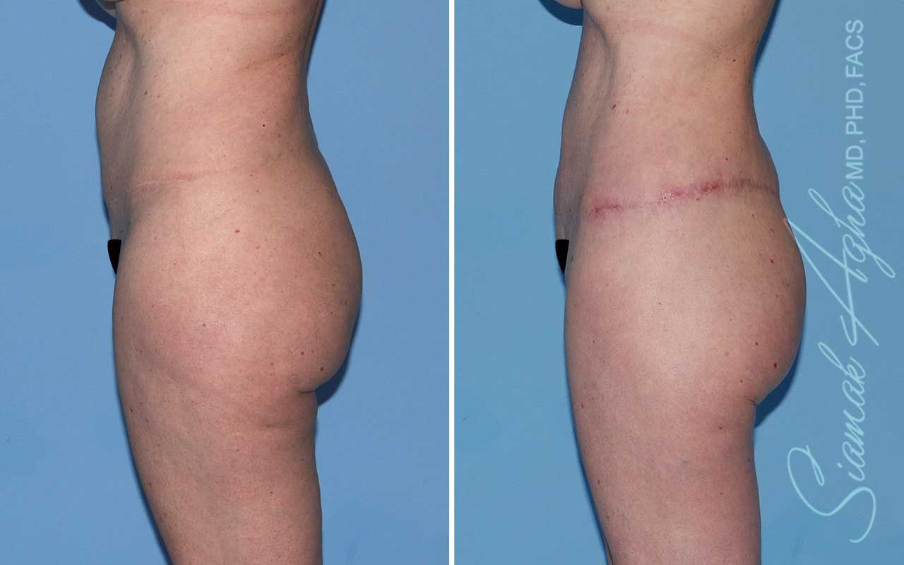 Lower Body Lift Before & After