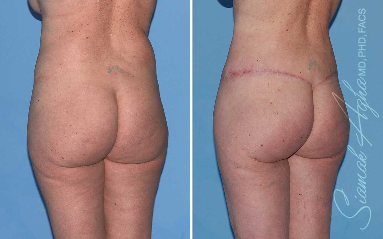 Lower Body Lift Before & After