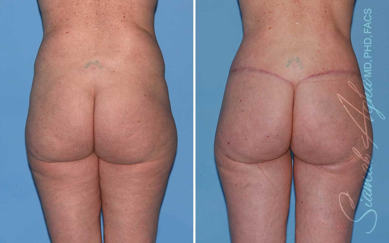 Lower Body Lift Before & After