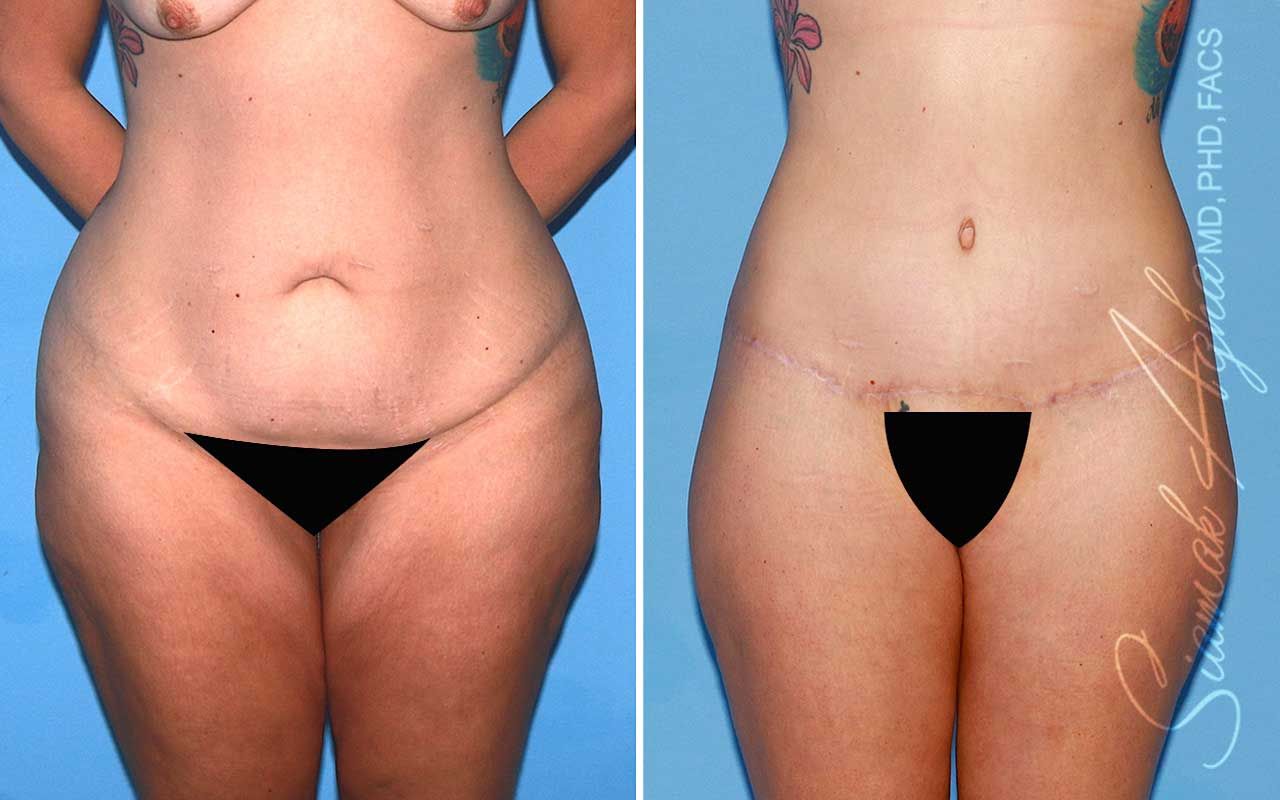 Lower Body Lift Before & After