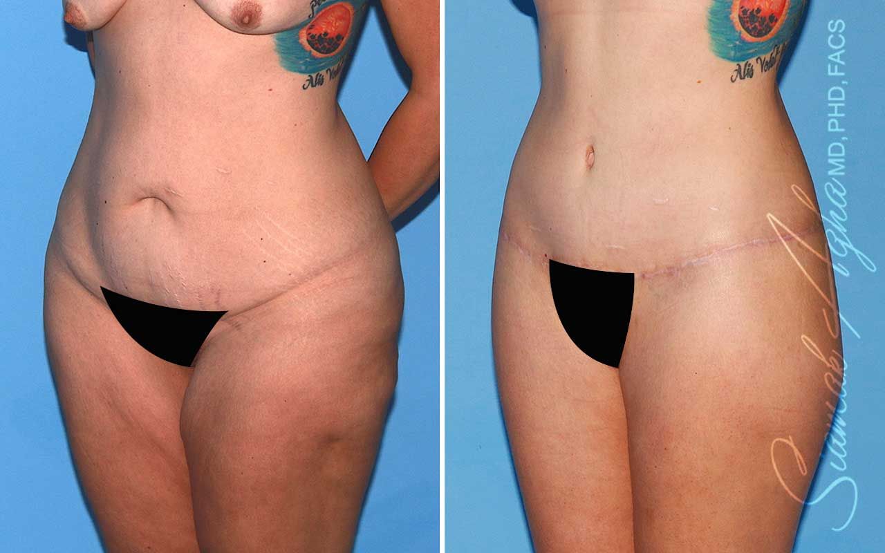 Lower Body Lift Before & After