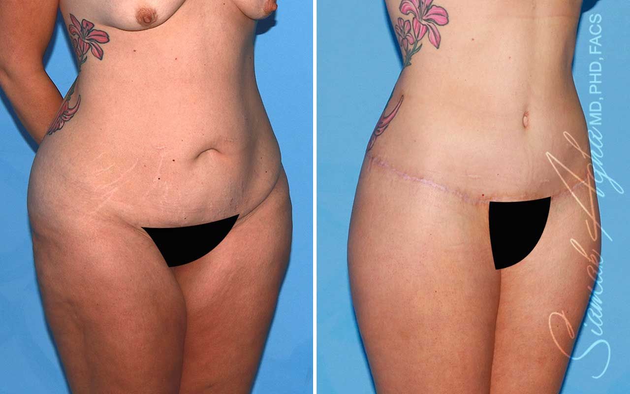 Lower Body Lift Before & After