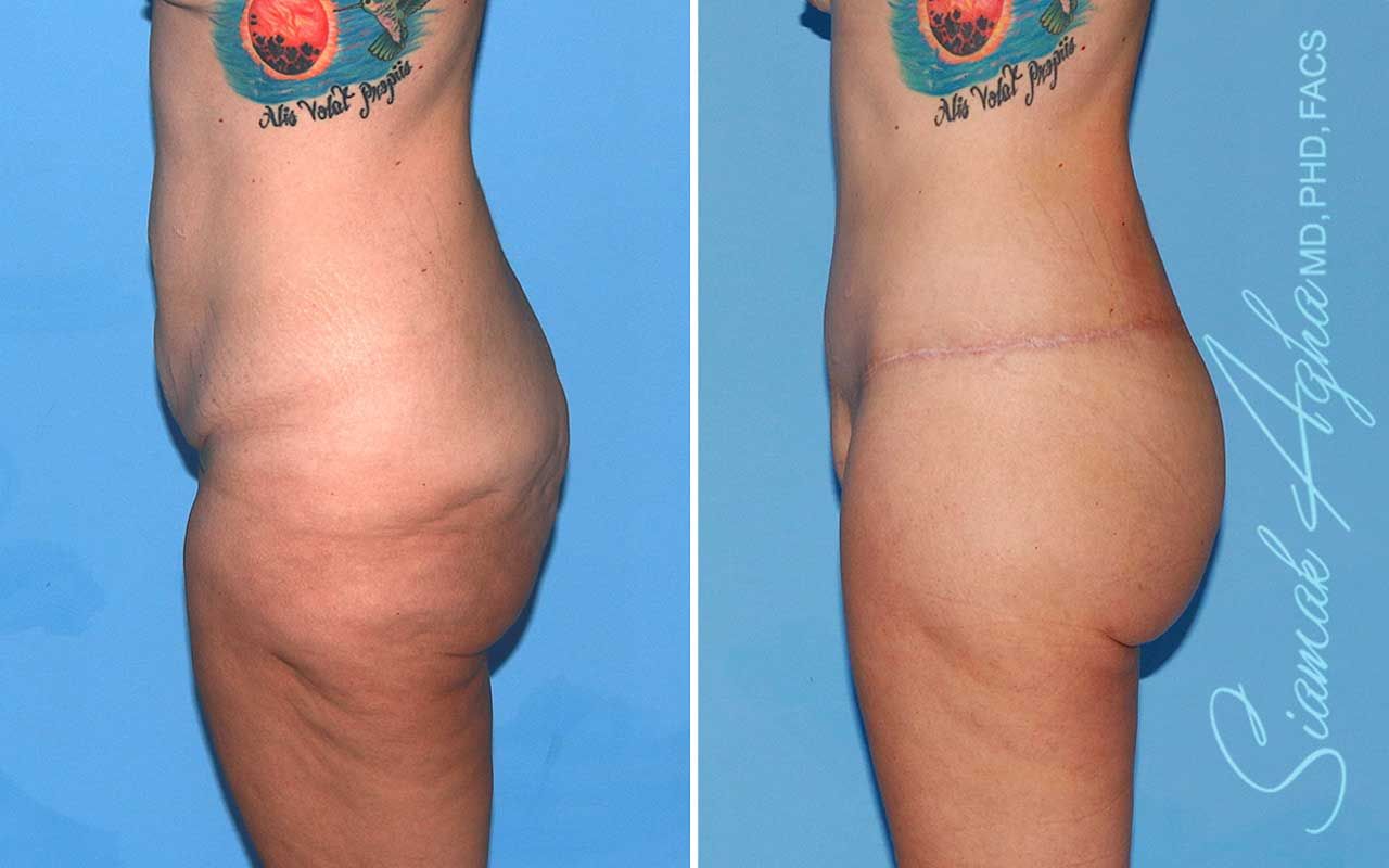 Lower Body Lift Before & After