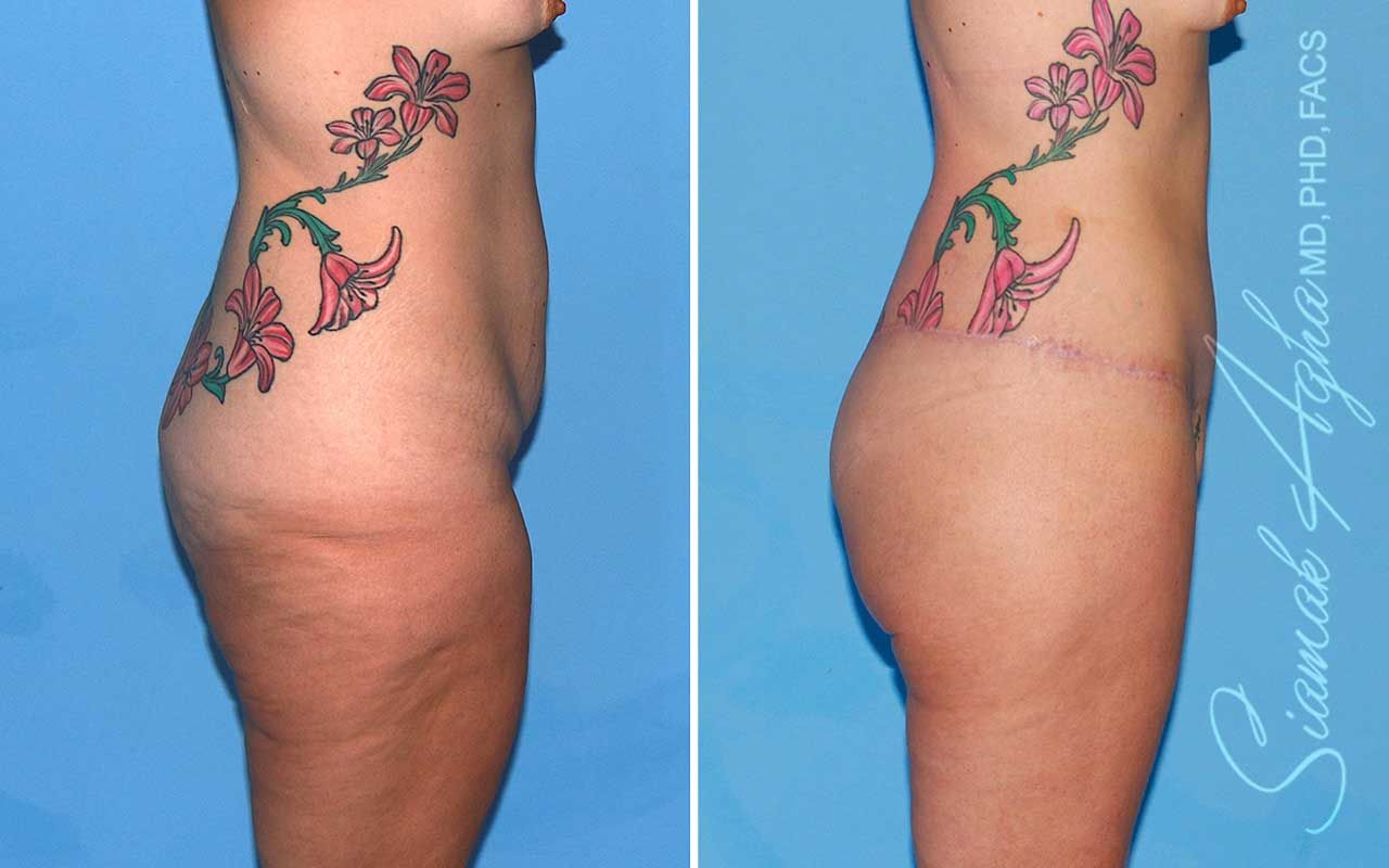 Lower Body Lift Before & After