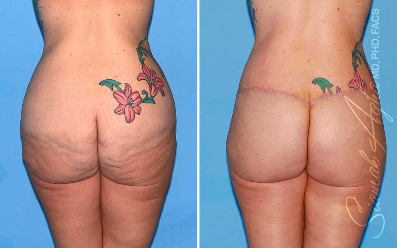 Lower Body Lift Before & After