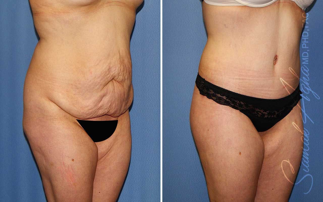 Lower Body Lift Before & After