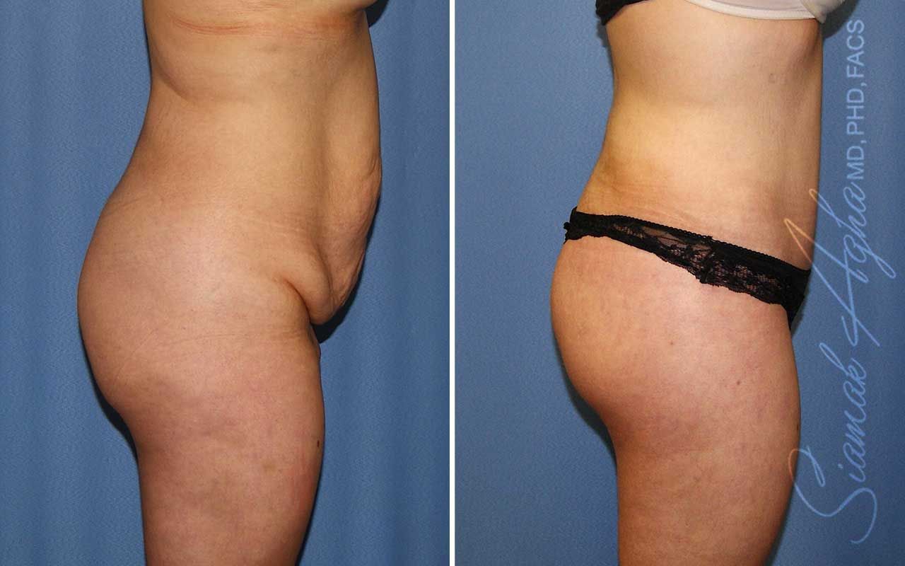 Lower Body Lift Before & After