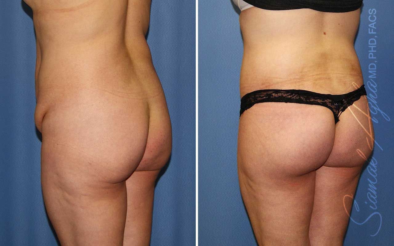 Lower Body Lift Before & After