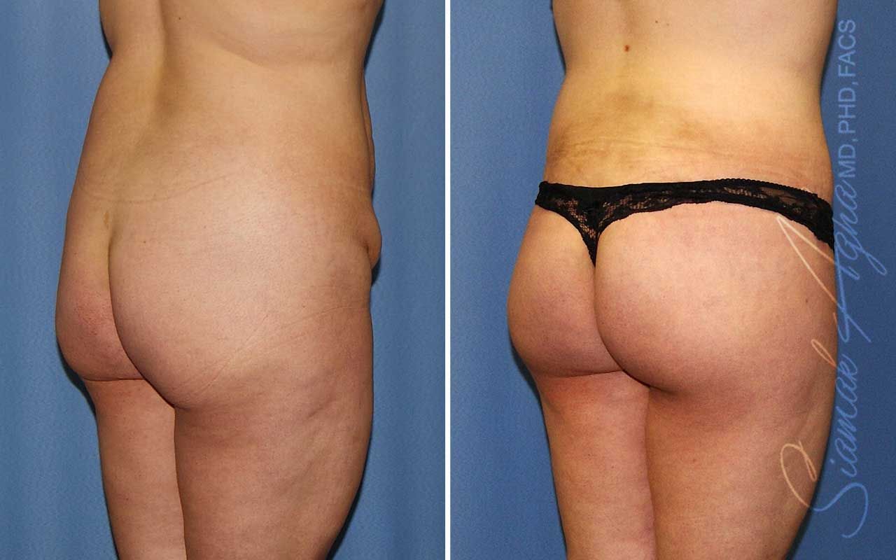 Lower Body Lift Before & After