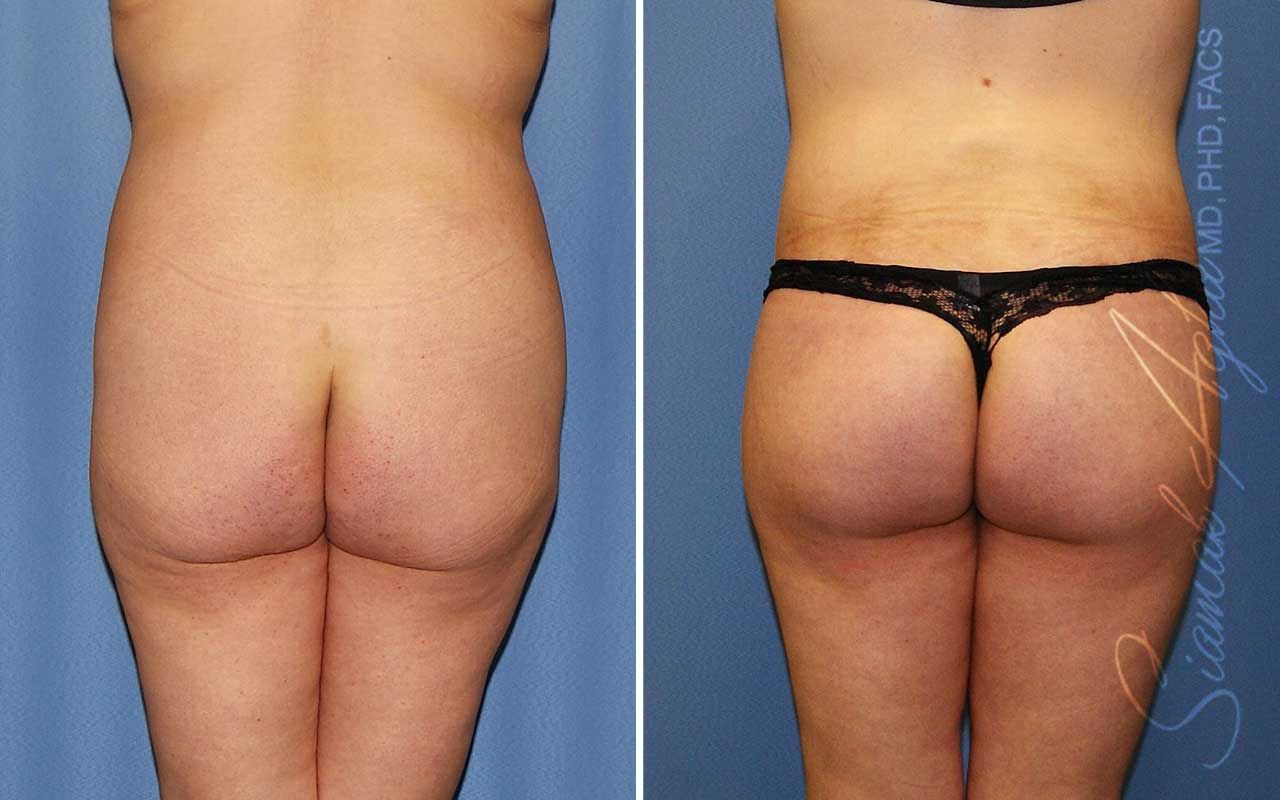 Lower Body Lift Before & After
