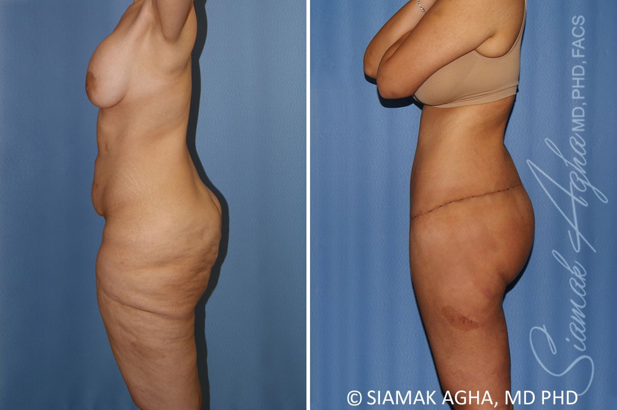 Lower Body Lift Before & After