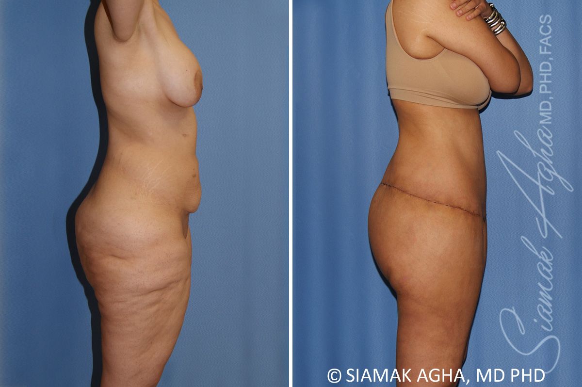 Lower Body Lift Before & After